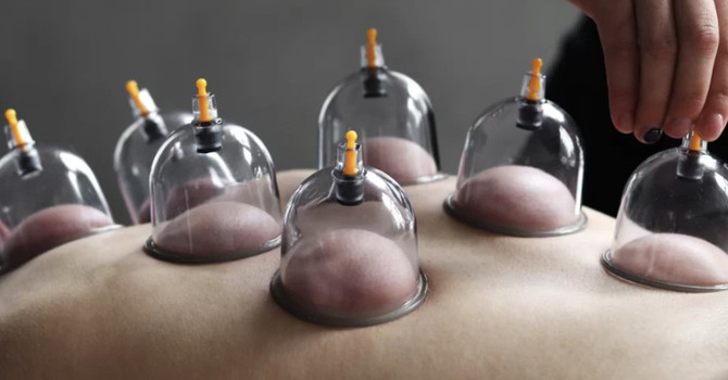 Cupping Therapy