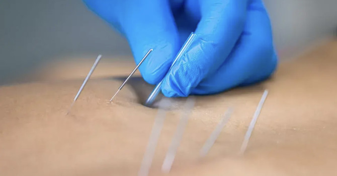 Dry Needling