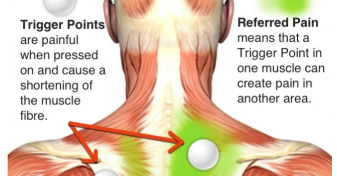 Understanding Trigger Points: Causes, Symptoms, and Effective Treatments