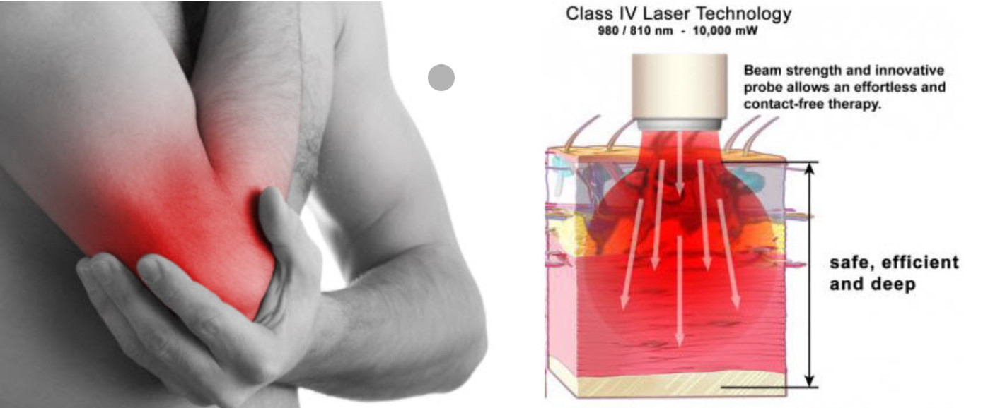Class IV Laser