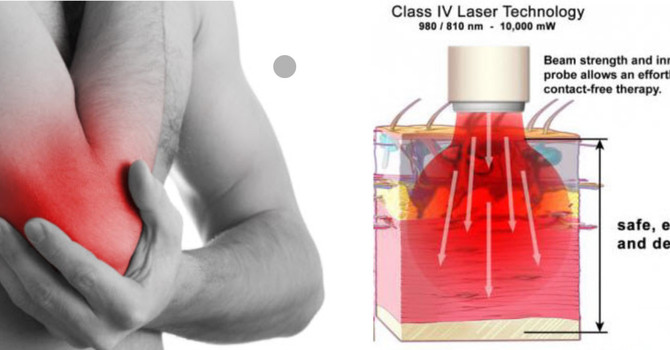 What Is a Class IV Laser and What Is It Used For?
